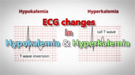 Hypokalemia ECG Changes [With Examples] Manual Of Medicine, 56% OFF