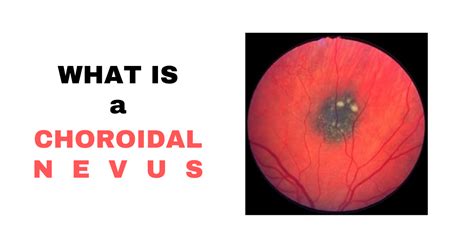 Choroidal Nevus - Nader Moinfar, MD, MPH, FACS, FASRS