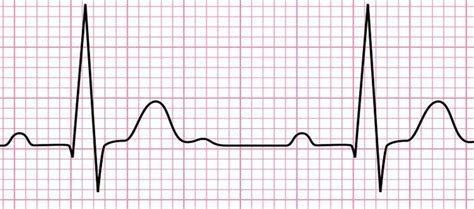 Electrocardiogram (ECG): working principle, normal ECG wave, application of ECG - Online Biology ...