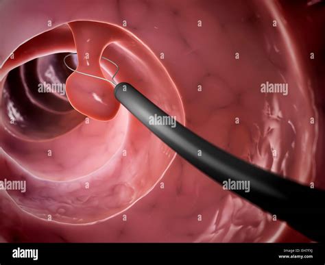 Colonoscopy Polyp Removal