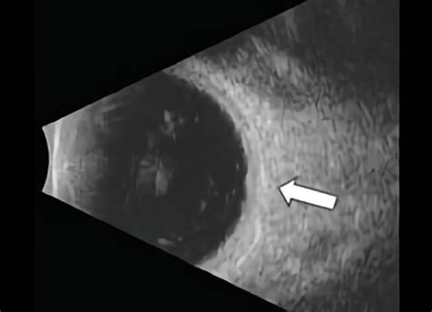 Choroidal Nevus Treatment | Retinal Consultants Medical Group