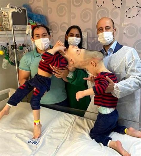 3-Year-Old Conjoined Twins with Fused Brains Separated in Brazil