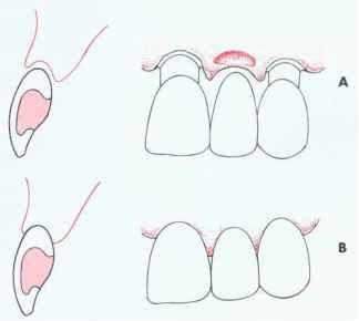 Ovate Pontic - Tooth Structure - Mussen Healthcare