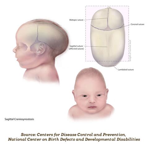 Uneven Head Shape in Babies: Causes and Treatment of Craniosynostosis ...