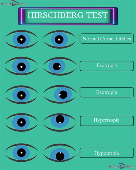 Hirschberg test - OptomInSight