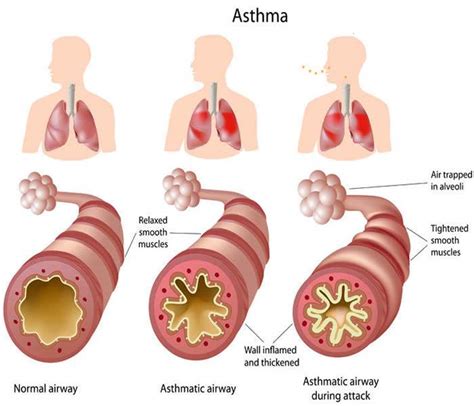 Natural Therapy for Asthma Cough :: Galleria Health and Lifestyle, Nigeria