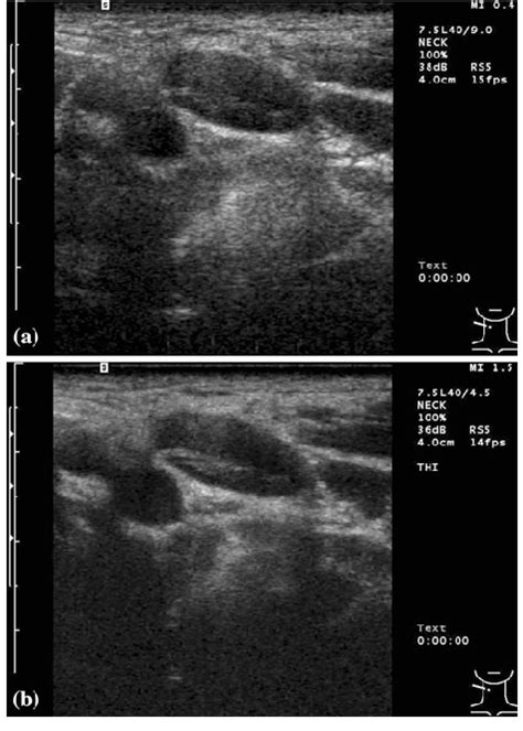 Internal jugular lymph node without abnormal findings. a 9.0-MHz FI... | Download Scientific Diagram