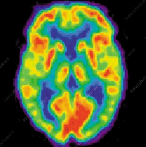 PET scan of a normal brain - Stock Image - C005/1680 - Science Photo Library