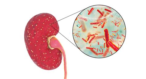 Acute Pyelonephritis - HOSPITALS MAGAZINE