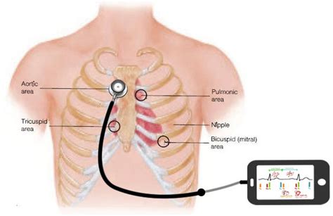 Schematic diagram for heart sound acquisition using a smartphone. The ...