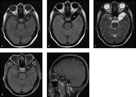 17 Arachnoid Cysts | Radiology Key