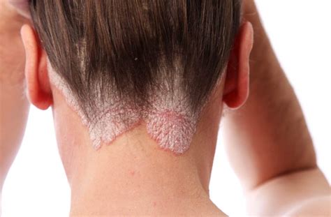 Plaque psoriasis scalp pictures | Symptoms and pictures