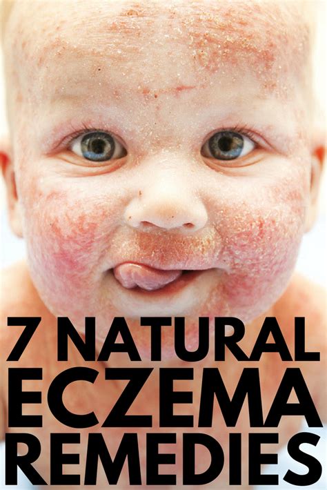 Natural eczema treatment: 7 natural ways to treat eczema that work!