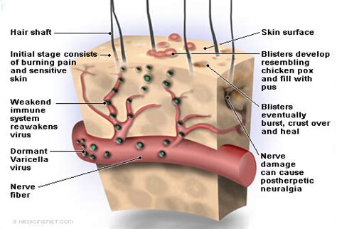 Shingles (Infections) - Apex Dermatology & Skin Surgery