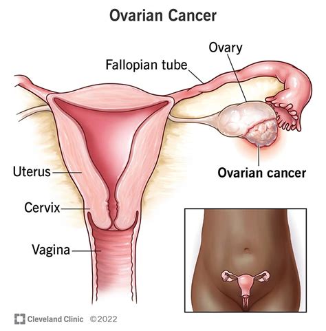 Ovarian Cancer: Symptoms, Diagnosis & Treatment