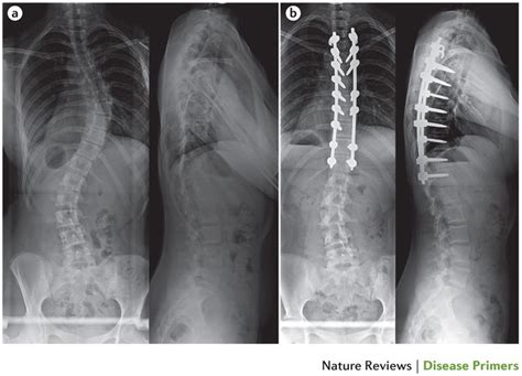 scoliosis xray before after surgery