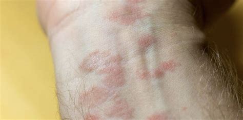 Scabies Rash Chest