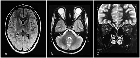 Normal Optic Nerve Mri