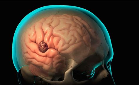 Brain Diseases: 10 Common Brain Diseases