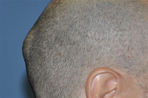 Lump On Back of Head: Learn Most Common Reason of Bump on Back of Head