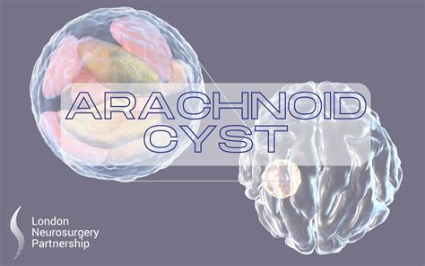 Arachnoid cyst - London Neurosurgery - Spine & Neurosurgery