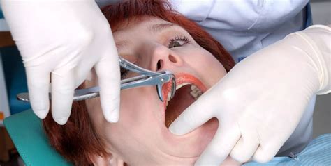 broken tooth extraction procedure Archives - Elite Dental Care