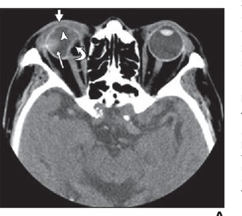 Figure 1 from CT of globe rupture: analysis and frequency of findings. | Semantic Scholar