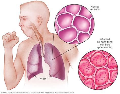 Pneumonia - Symptoms and causes (2023)