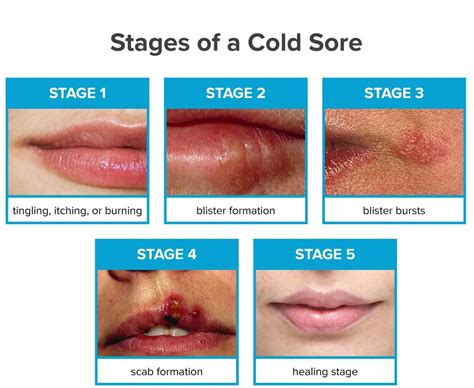 Cold Sores stages - Philadelphia Holistic Clinic