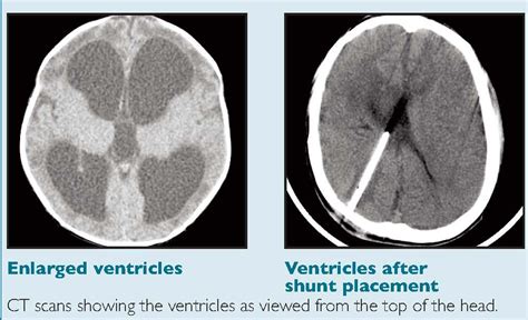 Hydrocephalus shunt komplikationer – Spegel med belysning