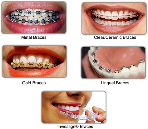 Best 25+ Different types of braces ideas on Pinterest | String bracelet making, Braces types and ...