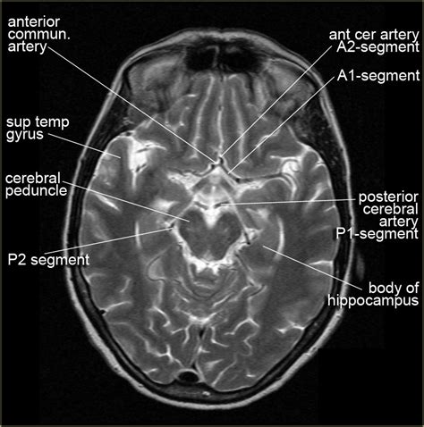 Anatomy Of Brain Ct Scan Anatomy Drawing Diagram | Images and Photos finder