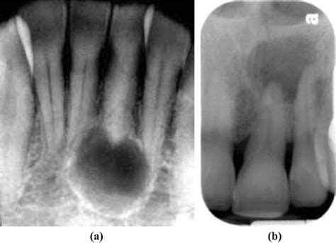 Periapical Cyst