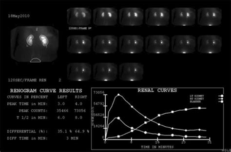 Renal Scan Procedure