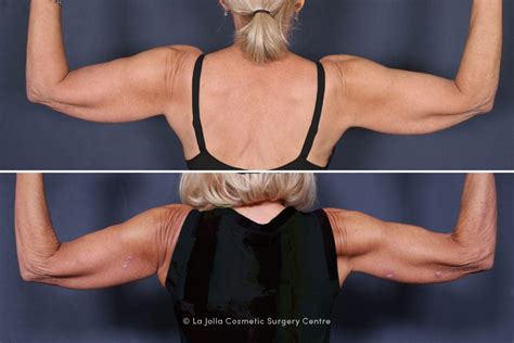 Upper Arm Lift | San Diego | La Jolla Cosmetic Surgery Centre