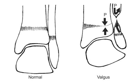 Proposed mechanism for gradual development of the valgus ankle...