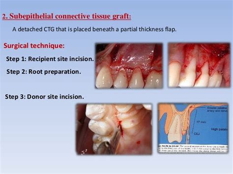 Mucogingival surgery