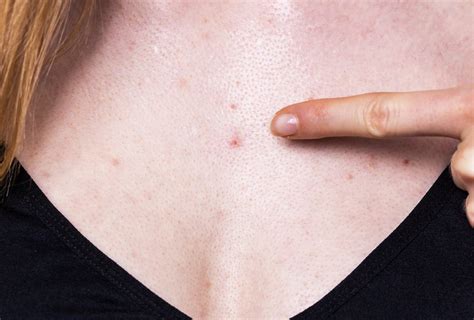 Chest Acne: Causes & 5 Ways to Get Rid of It - eMediHealth