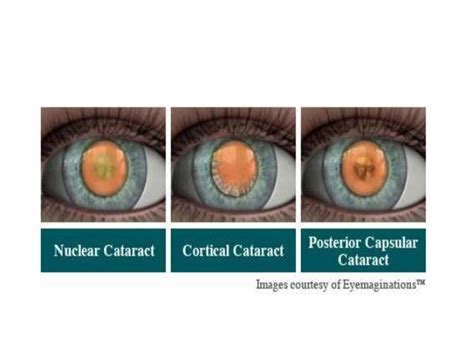 Cataract