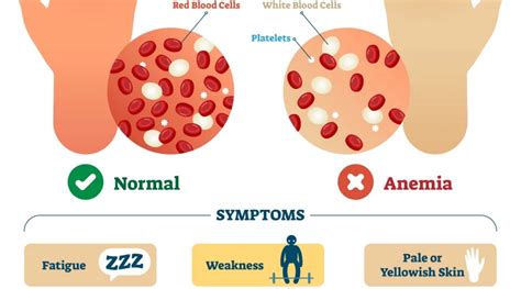 severe anemia symptoms Archives - SAMARPAN PHYSIOTHERAPY CLINIC AHMEDABAD