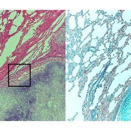 (a) Histology of the pulmonary hamartoma. The section showing the... | Download Scientific Diagram