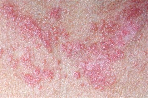 Lupus Rash Photograph by Dr P. Marazzi/science Photo Library