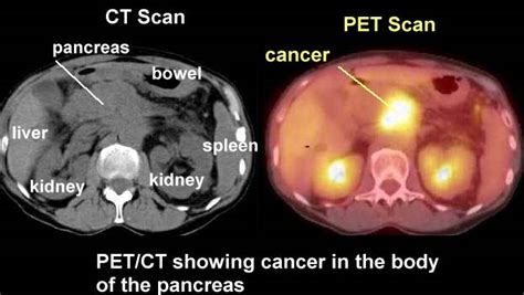 Anatomy of the Pancreas