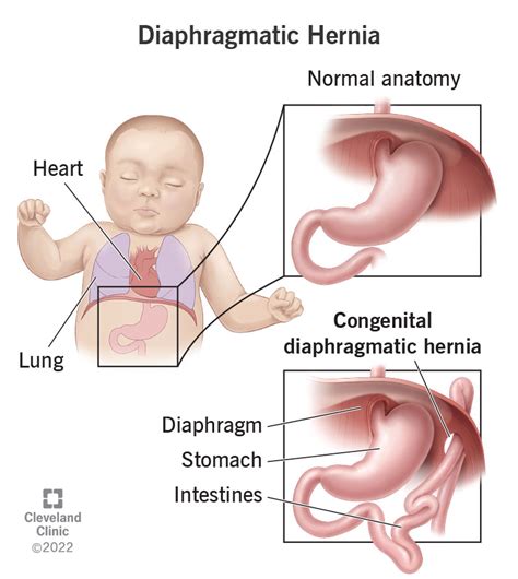 Hiatus Hernia Types, Causes, Symptoms, Complications,, 52% OFF