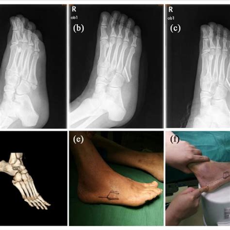 (a) The fifth metatarsal base avulsion fracture confirmed by X-ray. (b)... | Download Scientific ...