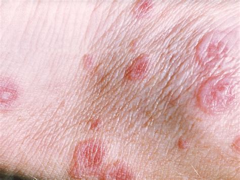 Fast Five Quiz: Erythema Multiforme