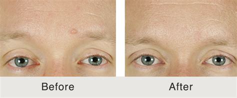 Before & After: Mole Removal | Carolina Facial Plastics