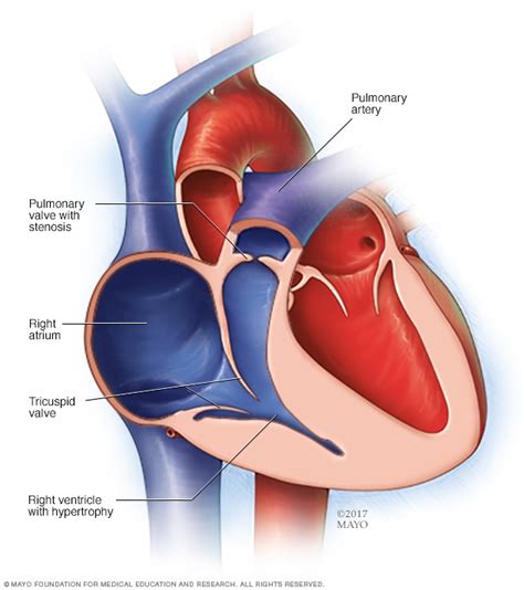 Pulmonary valve stenosis - Symptoms and causes - Mayo Clinic