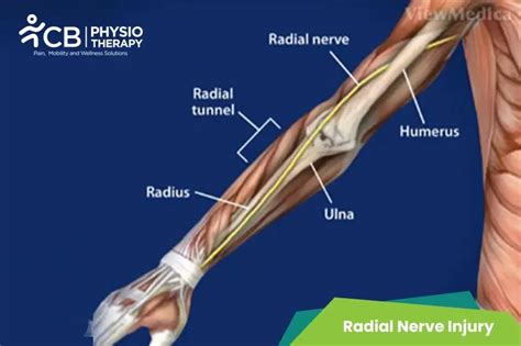 What Is Radial Nerve Injury?, Symptoms ,Causes, Diagnosis ...