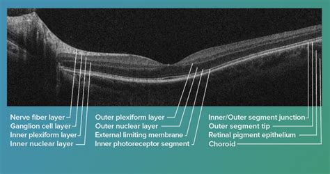 OCT in Ophthalmology - Wasatch Photonics